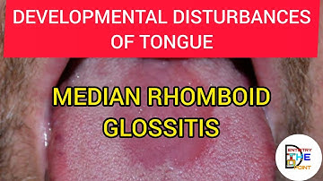 MEDIAN RHOMBOID GLOSSITIS - DEVELOPMENTAL DISTURBANCES OF TONGUE