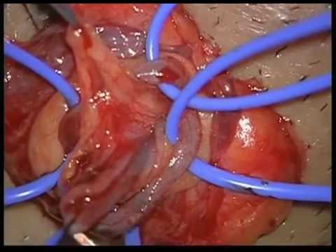 Operasi Varikokel urology