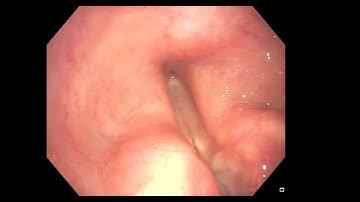 FIS exam laryngospasm and intubation from AOD