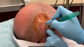 Large scalp infection