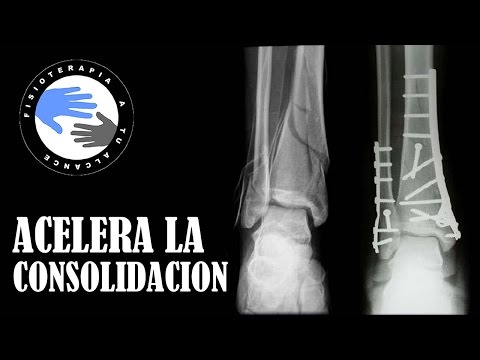 Video: Tornillo De Hielo 