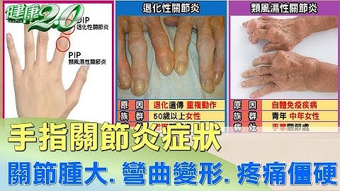 手指關節炎症狀！關節腫大.彎曲變形.疼痛僵硬 健康2.0 - 天天要聞