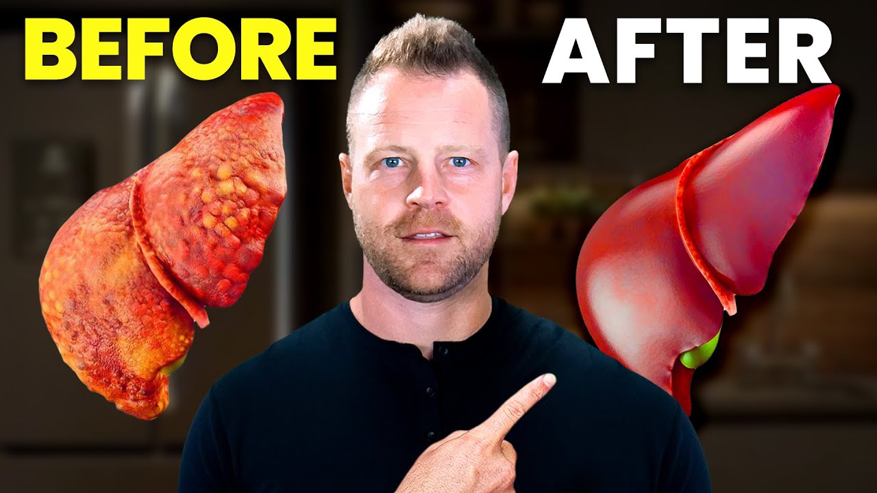 How to Fix Your Fatty Liver at Home...5 Tips YouTube