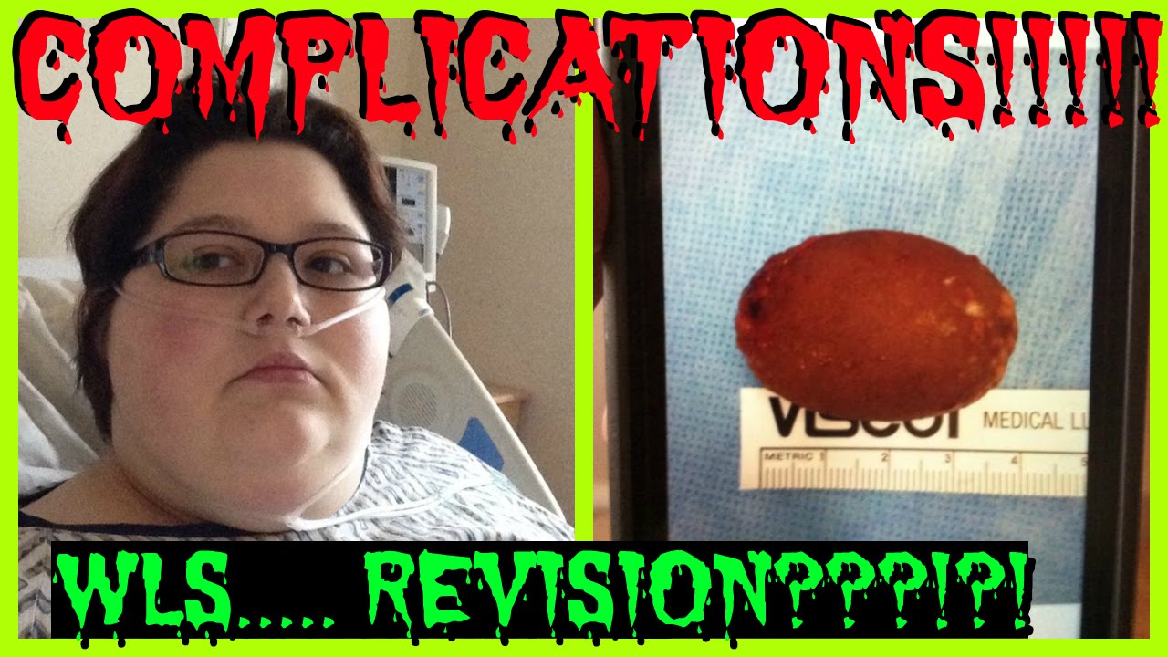 Weight Loss Surgery Complications & Revisions (Let Me Explain That