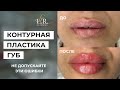 НЕ ДОПУСКАЙТЕ ЭТИ ОШИБКИ❗️Контурная пластика губ💉