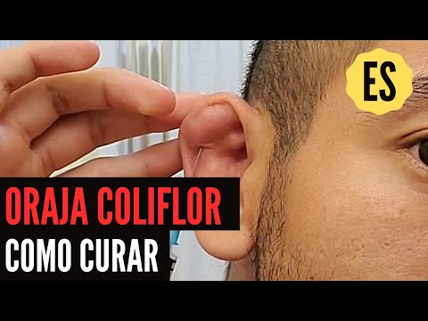 Video: 3 formas de drenar la oreja de coliflor