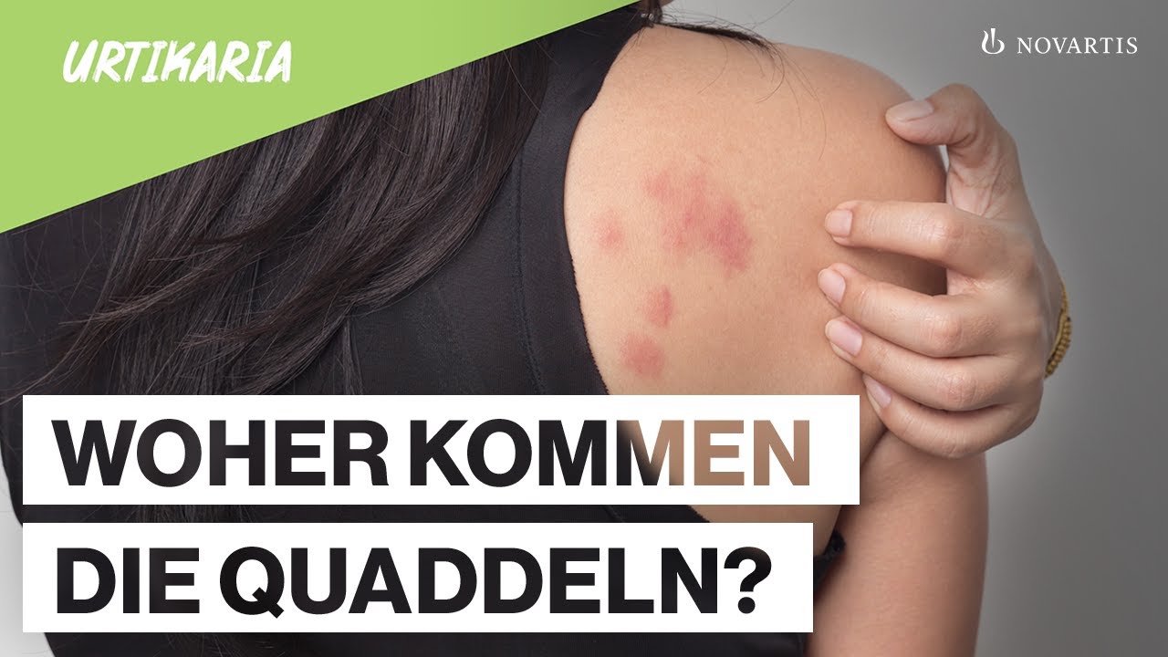 Was ist Nesselsucht?