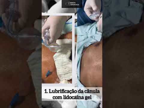 Vídeo: Quando trocar as cânulas?