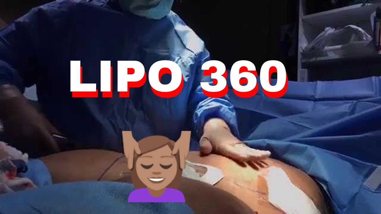 Laser LIPO 360 DAY of Surgery LIPO 360 San Antonio Austin Dallas