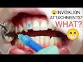 Invisalign Invisible Braces Attachments placement video , Dentist Pune , Orthodontist Pune, teeth