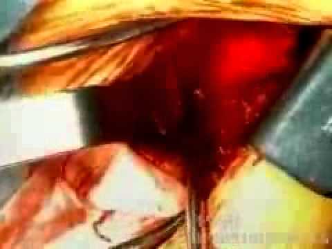 Traumatic Instability of the Shoulder: Verifying the location of the axillary nerve