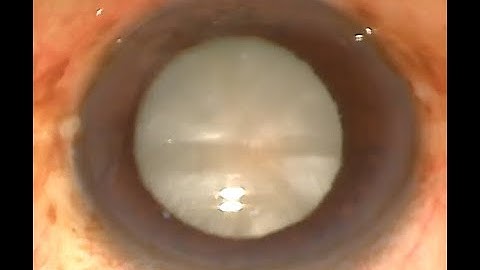 MSICS In An Intumescent Cataract with a Non-Well Dilating Pupil and Large Nucleus in 8 Minutes HD