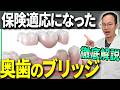 【速報】奥歯の銀歯はおしまい？！保険適応になった奥歯のブリッジを歯医者が解説します