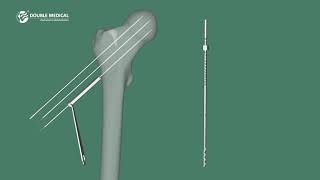 Double Medical 7.3mm Cannulated Screw