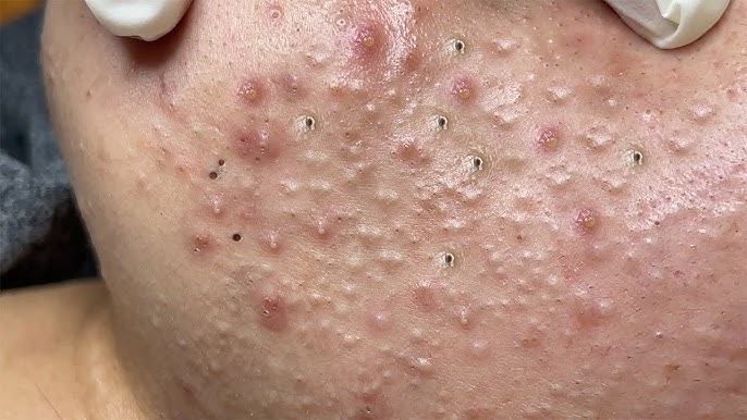 Big Cystic Acne Blackheads Extraction Blackheads & Milia, Whiteheads  Removal Pimple Popping # 3817 - YouTube