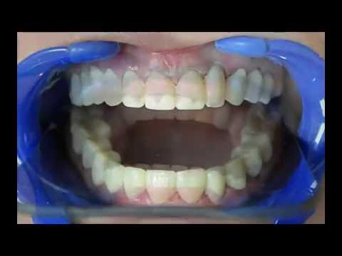 Cuanto cuesta un implante dental de una muela guatemala