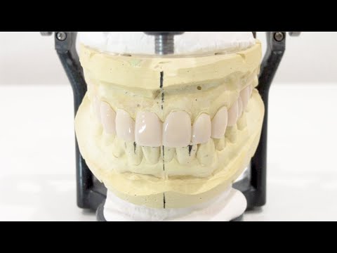 The whole process until the temporary tooth is completed/仮歯ができるまで〜at TOKYO ADVANCED MEDICAL CLINIC