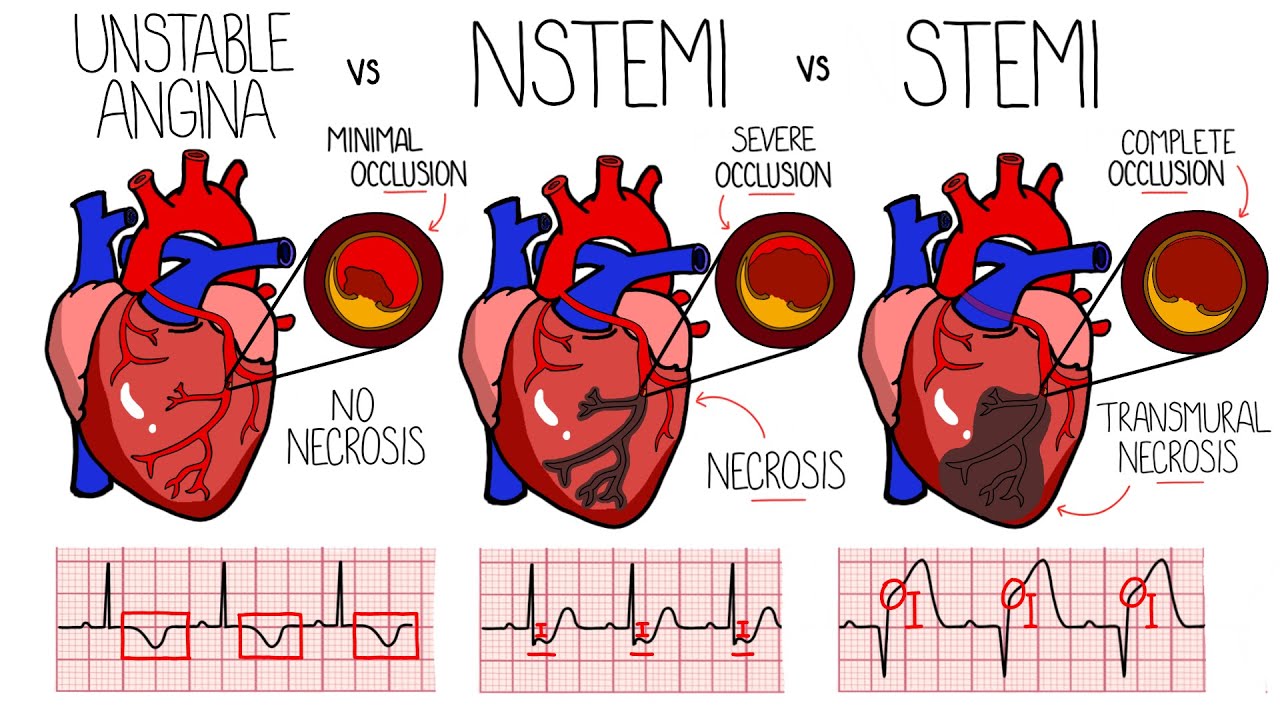 Acute Coronary Syndrome Heart Attack Unstable Angina Vs Nstemi Vs