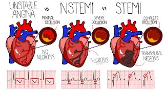 Acute Coronary Syndrome (Heart Attack)  Unstable Angina vs NSTEMI vs STEMI | With ECGs