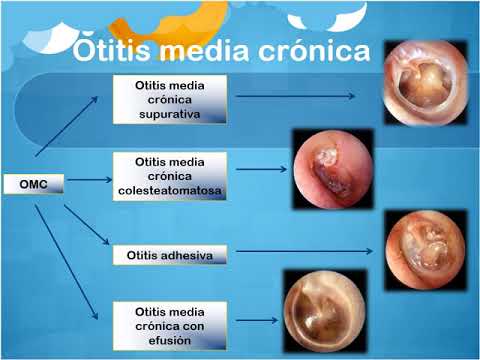 Video: Otitis Crónica