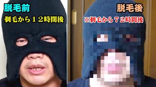 医療レーザー脱毛で「髭脱毛」した結果が凄かったので、シェアします。