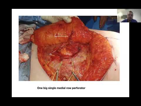 DIEP flap reconstruction Tips and Tricks Korean Society of Plastic Surgery