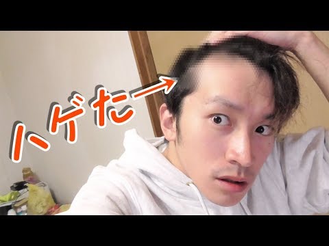 悲報 マジでハゲてきた どうすればいいですか Youtube