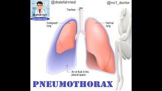 Pneumothorax  / Causes /  Pathology / Symptoms / Diagnosis / Treatment / Medical Lecture / No1doctor
