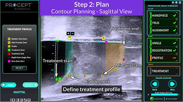 Aquablation® Therapy with the AQUABEAM® Robotic System for lower urinary tract symptoms due to BPH