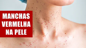 O que pode causar manchas vermelhas na pele que coçam?