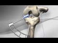 Lsion du ligament crois antrieur dt4 entorse du genou  avignon 84