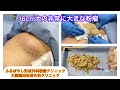 大腿部の非常に大きな粉瘤　ブログでも粉瘤について詳しく解説してます。東京皮膚のできものと粉瘤クリニック　ふるばやし形成外科新宿院　大阪梅田形成外科クリニック