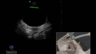 3. How To EFAST   Pelvis Sonosite.