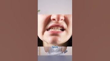 Răng hô là gì?? | Lạc Việt Intech Niềng Răng #shorts