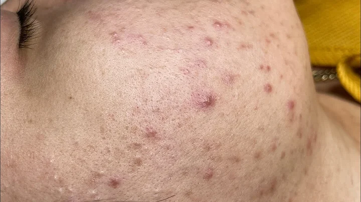 Relaxing Acne Treatment #188(Linh My Dang)P1