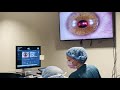 Live PRK Procedure at Commonwealth Eye Surgery