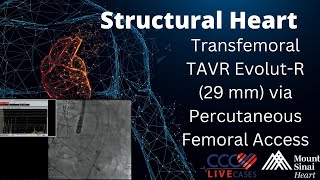 SAPIEN 3 TAVR (26mm) via Percutaneous Femoral Access - Structural Live Jan 2017
