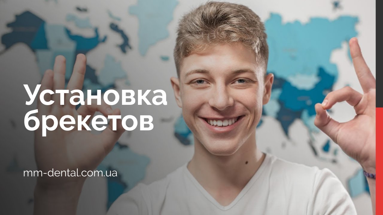 Установка брекетов - YouTube