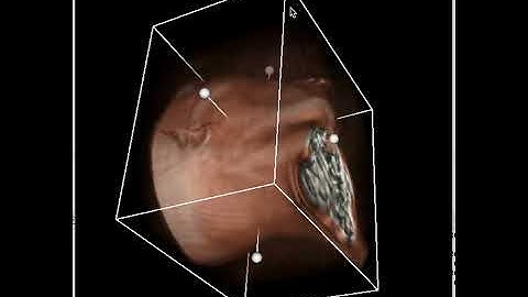 VR -Volume Rendering-