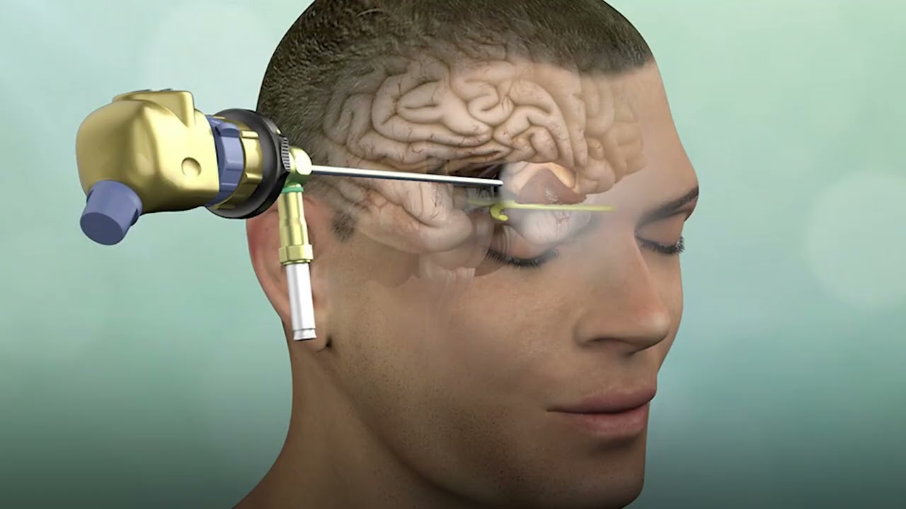 أورام قاع الجمجمة و الغدة النخامية | دكتور خالد الشاذلي