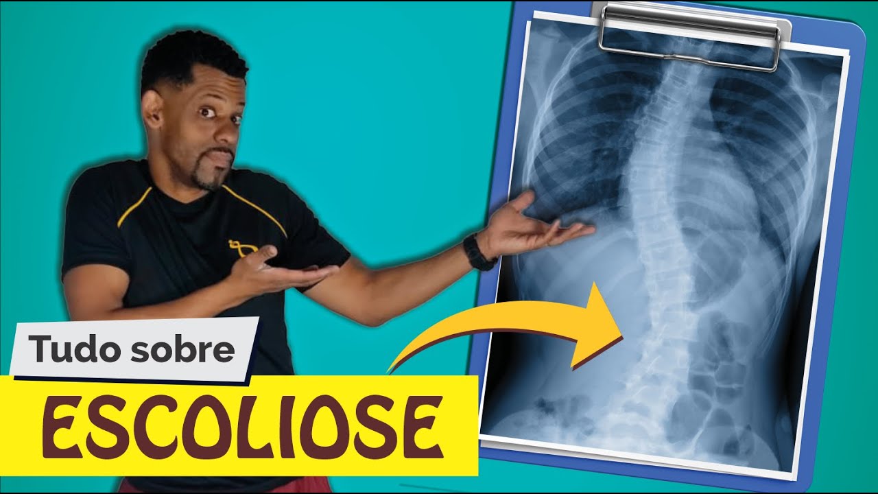 Tudo sobre escoliose - Explicação Teórica + AUTO AVALIAÇÃO -  Rodrigo Lopes Fisioterapeuta