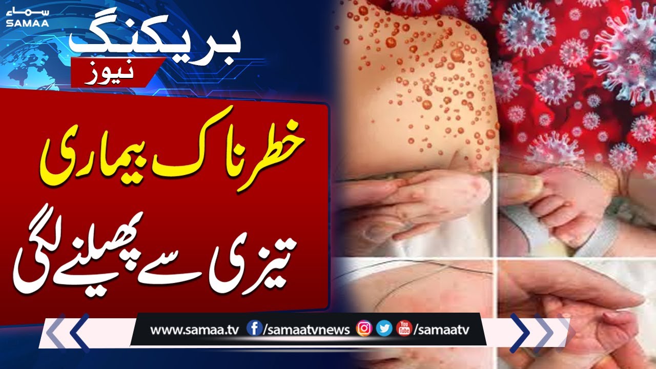 Monkeypox Cases increase in Pakistan | Govt in Action | Latest Health ...