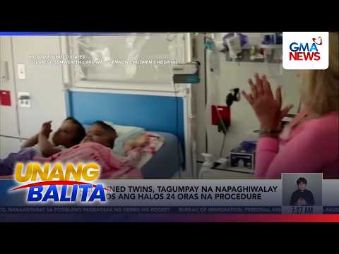 Conjoined twins, tagumpay na napaghiwalay matapos ang halos 24 oras na procedure | Unang Hirit