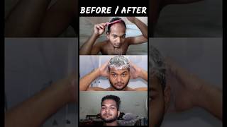 क्या MINOXIDIL से बाल वापस आते हैं? MINOXIDIL REVIEW #shorts #viral #minoxidilresults screenshot 4