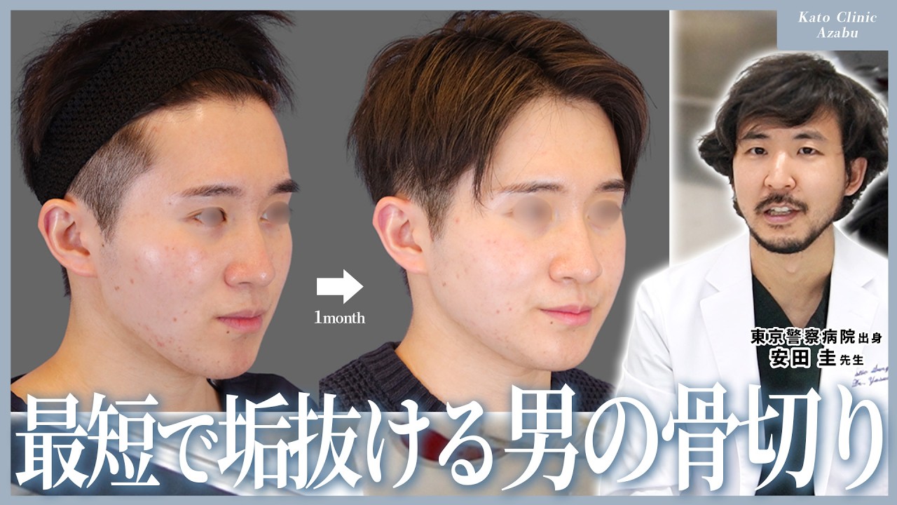 Facial Contouring] We explain a case study that maximized a