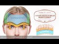 Brow Lift 101 : Differences between brow lifting techniques - Part II | Aesthetic Minutes #Browlift