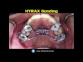 bonding HYRAX expander in orthodontics- maxilla expansion-orthodontic education and courses
