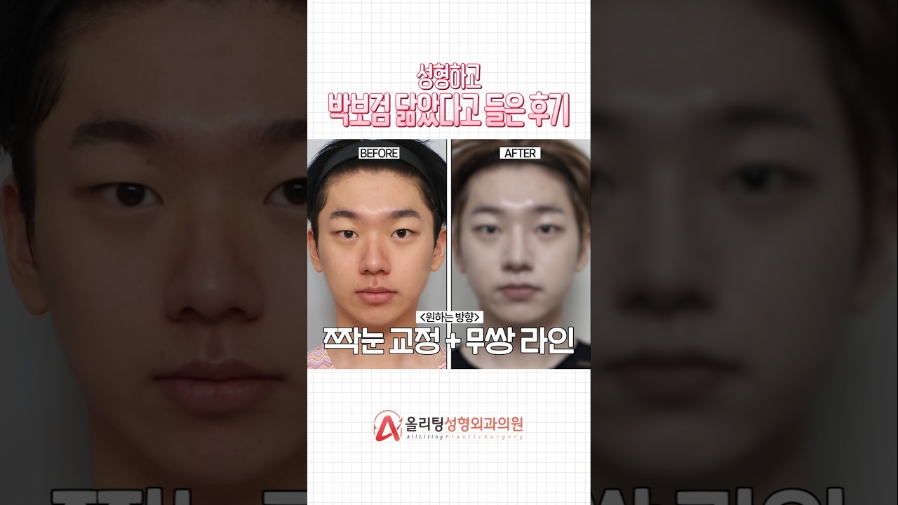 [奧利婷整形外科診所] 整形後被說像朴寶劍的經歷分享！ #雙眼皮手術 #隆鼻 #shorts #話題 #issue