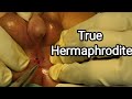 46XX True Hermaphrodite reared up as a boy !