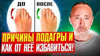 Подагра? Её Не Будет! Причины Подагры И Её Лечение!